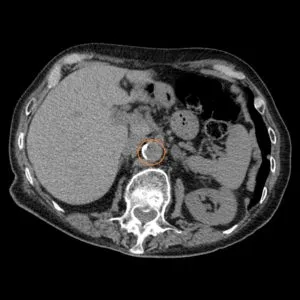 Intravenoasă contrastantă tomografie computerizata abdominala comparativ cu