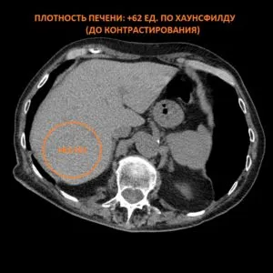 Intravenoasă contrastantă tomografie computerizata abdominala comparativ cu