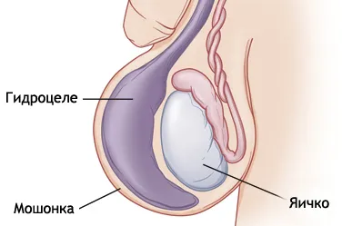 Hydrocele férfiaknál okoz, kezelés, műtét