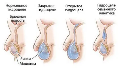 Hydrocele férfiaknál okoz, kezelés, műtét