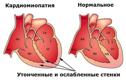 Вплив алкоголю на серце