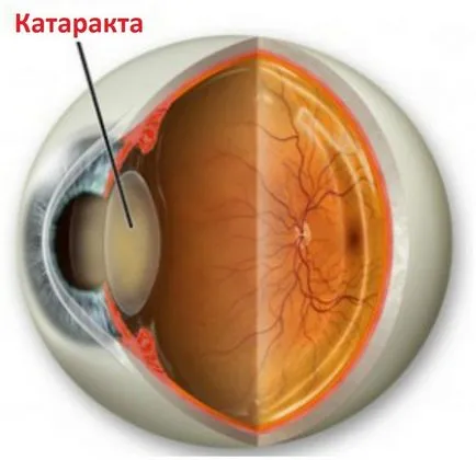 cataracta congenitale la copii cauze, tratament, indicații pentru o intervenție chirurgicală