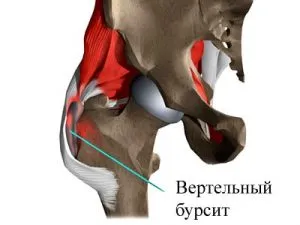 В криза на бедрото причинява болка