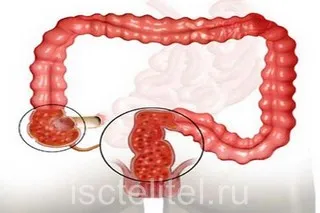 Хронична спастичен колит