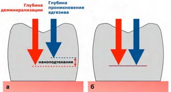 Химически избелване на зъбите