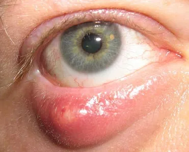 Chalazion симптоми, причина за заболяване, диагноза, лечение и профилактика на Chalazion