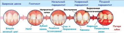 Cauzele periodontita cronica, simptome, stadii, prevenirea