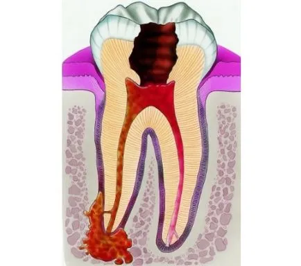 A krónikus foggyökérhártya okok, tünetek, szakaszok, megelőzés