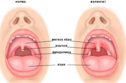 класификация заболяване на устната кухина, профилактика и лечение на