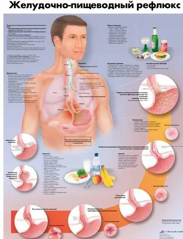 Turnarea bila in cauzele esofag, simptome, tratament și prognostic