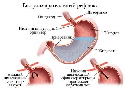 Turnarea bila in cauzele esofag, simptome, tratament și prognostic