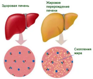 Steatoza hepatică ca medicație medicate, nutriție și dietă