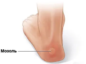 Сърбеж и зачервяване на кожата на първа тревога крак