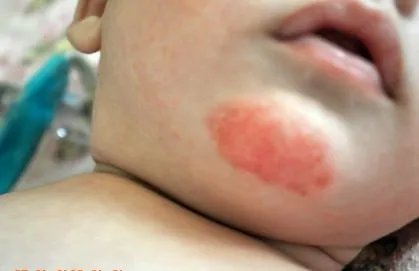 Allergia gyermekeknél típusú allergia tesztek és kezelés