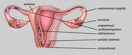 ademioza uterin - Ce este, simptome și tratament