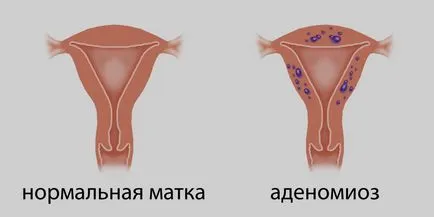 матката аденомиоза - Какво е това, симптоми и лечение