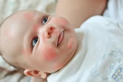 Allergia a baba céklát és a felnőttek hogyan teremthettek, tünetek, diagnózis, kezelés