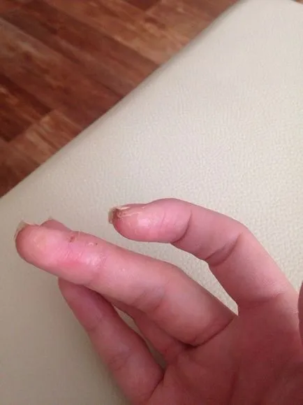 Алергия към Naroscheny нокти - красива мода