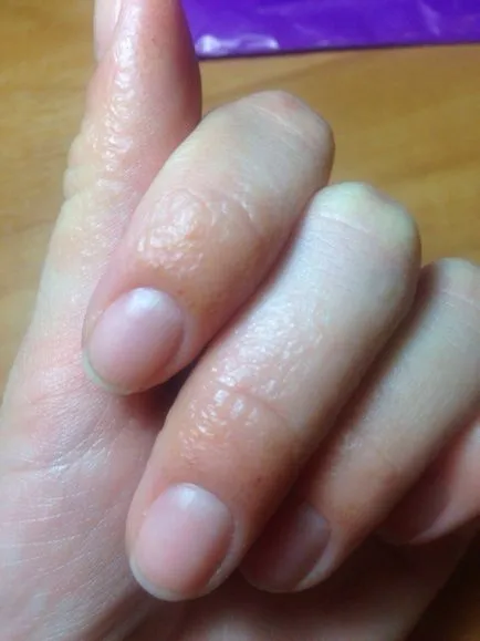 Алергия към Naroscheny нокти - красива мода