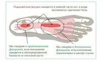 Aponevrosa simptome inflamație plantară ligamentelor lung