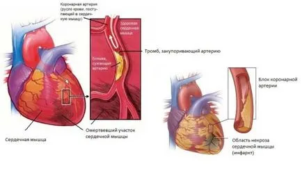 forme atipice de caracteristici generale infarct miocardic