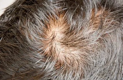 Alopecia androgenetica la femei și bărbați, simptome și tratament