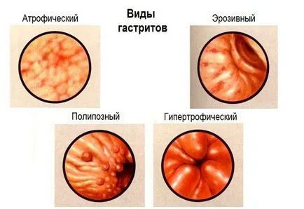 Antrale gastrita - eroziva, suprafață, simptome și tratament