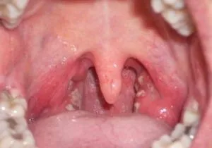 Белите гнойни пъпки в гърлото причини, симптоми, как за лечение на язви