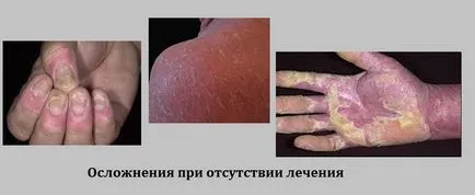 Plakkos psoriasis, mi ez, és hogyan kell kezelni azt