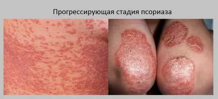 Plakkos psoriasis, mi ez, és hogyan kell kezelni azt