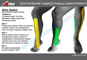 Болка в надкостницата при бягане