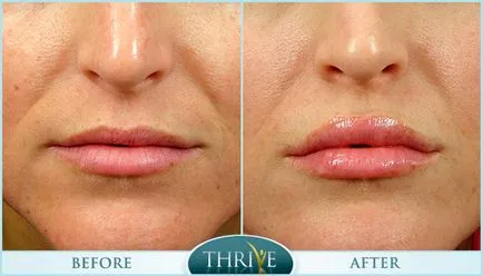 Botox ajkak javallatok, ellenjavallatok, költség, fotók előtt és után