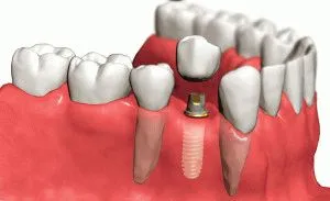 5 plus și minus implanturi dentare