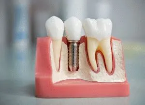 5 plus și minus implanturi dentare