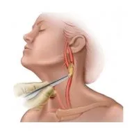 Aneurysm arteria carotis (nyaki erek) kezelésére, a tünetek