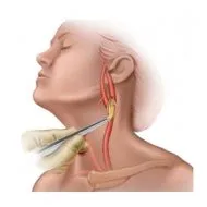 Аневризма каротидна артерия (съдове врата) лечение, симптоми