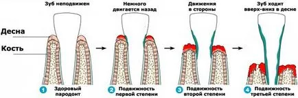 Антибиотици в периодонтит, лечение на периодонтит с антибиотици