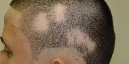 Alopecia la copii și formele focale totale ale cauzelor și tratamentul