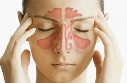 Allergiás sinusitis tünetek és a kezelés