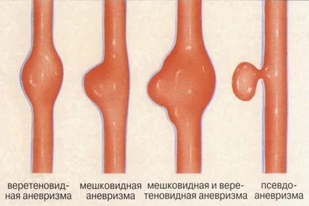 Anevrismul arterei carotide diagnostic, tratament si prevenire