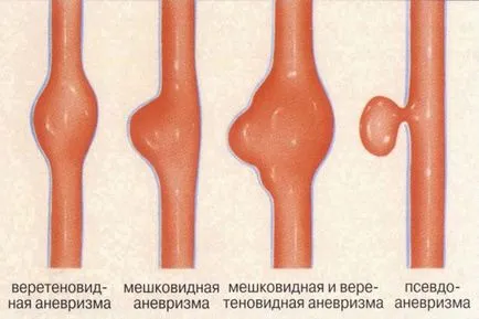 Aneurysm carotis - Causes, tünetek és kezelés