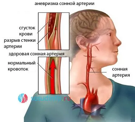 Aneurysm arteria carotis (nyaki erek) kezelésére, a tünetek