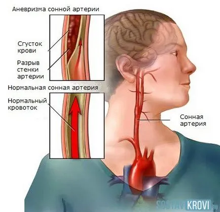 Аневризма на каротидната артерия на шията, причините, симптоми, лечение, хирургия, диагностика и профилактика