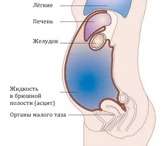 Ascites májzsugor