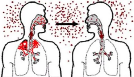 Amigdalite bacteriene cum să se facă distincția modul de a trata copiii