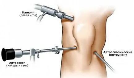 Térd arthroscopy típusok javallatok és ellenjavallatok, szakaszában a működés és a rehabilitáció,