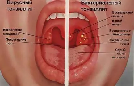 Бактериалната тонзилит как да се прави разлика как за лечение на деца