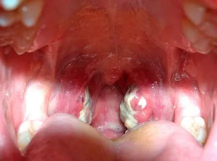 Бактериалната тонзилит (ангина) причини, симптоми, лечение