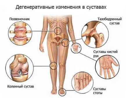 deformáló arthritis