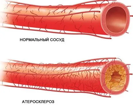 Атеросклерозата на големите артерии (маг) - на долните крайници, шията, мозъка,